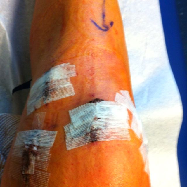 Knee Surgery Tattoos