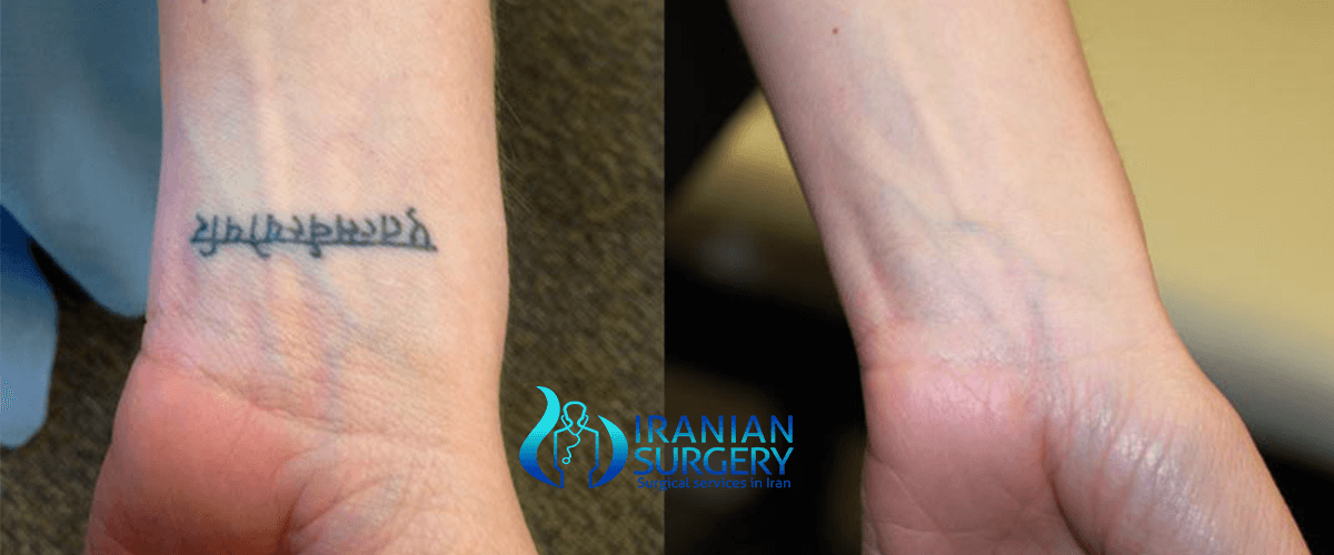 Tattoo Removal Surgery Lovely This Is Definitely Something I Would As A Tattoo My Tattoos For